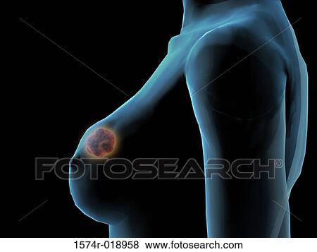 Stock Illustration - Breast Cancer. Fotosearch