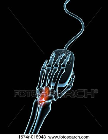Stock Illustration - Carpal Tunnel Syndrome. Fotosearch