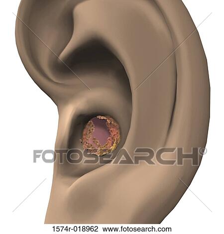 Drawing - Earwax. Fotosearch
