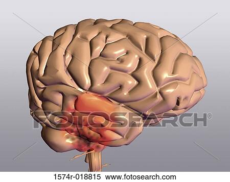 Parkinson's Disease View Large Illustration Stock Illustration - Parkinson's Disease. Fotosearch