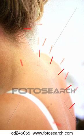 Alternative medicine, Close-up, Chinese medicine, back, acupuncture View Large Photo Image Stock Photography - Alternative medicine, Close-up, Chinese medicine, back, acupuncture. Fotosearch
