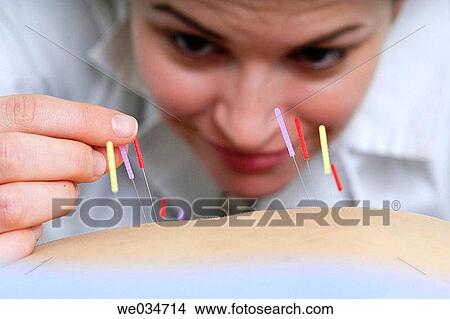 Acupuncture View Large Photo Image Picture - Acupuncture. Fotosearch
