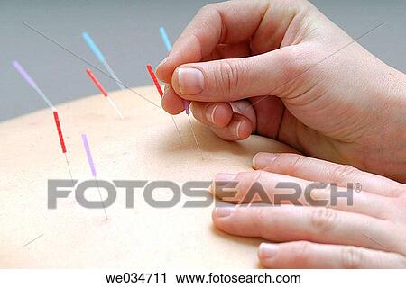 Acupuncture View Large Photo Image Stock Image - Acupuncture. Fotosearch