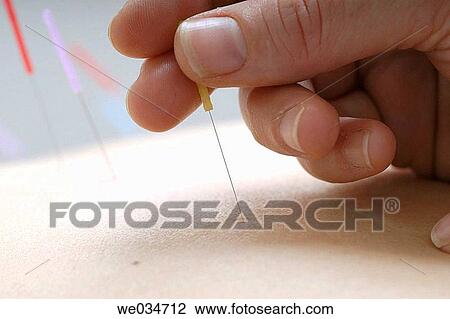 Acupuncture View Large Photo Image Stock Image - Acupuncture. Fotosearch