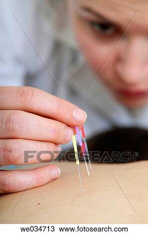 Acupuncture View Large Photo Image Stock Image - Acupuncture. Fotosearch