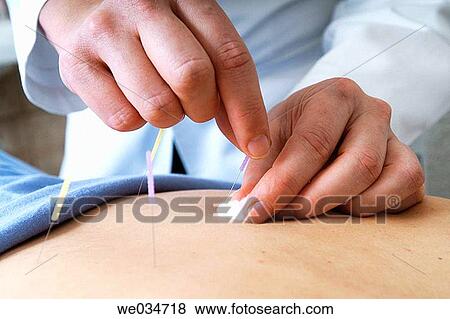 Acupuncture View Large Photo Image Stock Photo - Acupuncture. Fotosearch