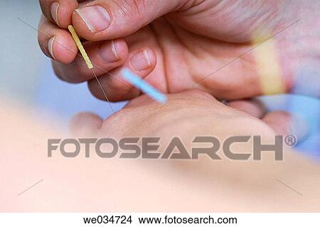 Alternative medicine, Close-up, Chinese medicine, acupuncture View Large Photo Image Picture - Alternative medicine, Close-up, Chinese medicine, acupuncture. Fotosearch