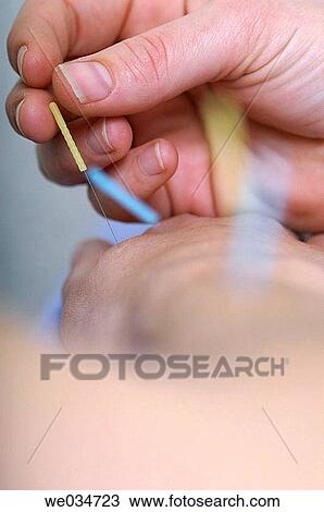 Alternative medicine, Close-up, Chinese medicine, acupuncture View Large Photo Image Stock Image - Alternative medicine, Close-up, Chinese medicine, acupuncture. Fotosearch