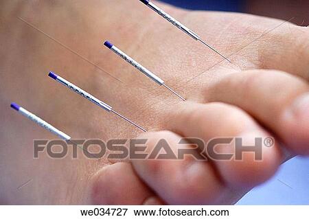 Alternative medicine, Close-up, Chinese medicine, barefoot, acupuncture View Large Photo Image Stock Photo - Alternative medicine, Close-up, Chinese medicine, barefoot, acupuncture. Fotosearch