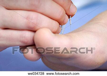 Alternative medicine, Close-up, Chinese medicine, barefoot, acupuncture View Large Photo Image Stock Photo - Alternative medicine, Close-up, Chinese medicine, barefoot, acupuncture. Fotosearch