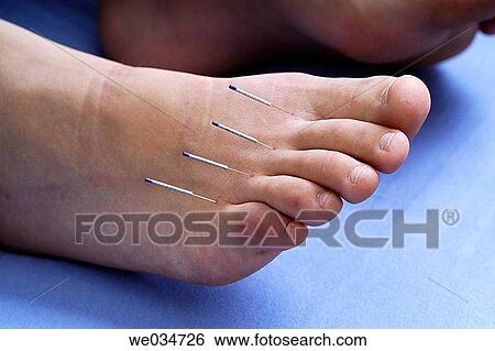 Stock Photograph - Alternative medicine, Close-up, Chinese medicine, barefoot, acupuncture. Fotosearch