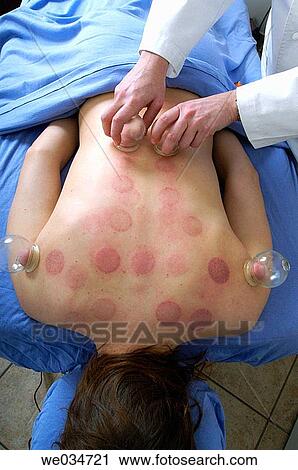 Cupping View Large Photo Image Stock Image - Cupping. Fotosearch