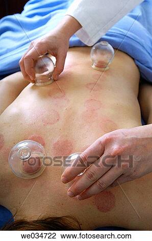 Stock Image - Cupping. Fotosearch