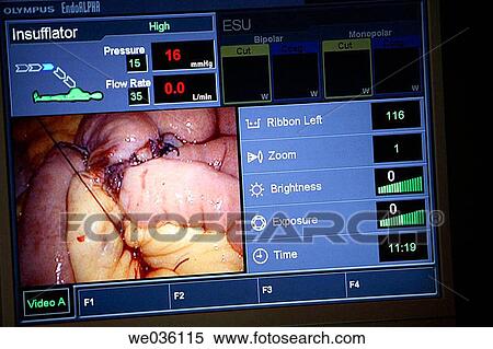 Monitor in operating room for liposcopic surgery View Large Photo Image Stock Photography - Monitor in operating room for liposcopic surgery. Fotosearch
