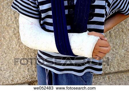 Broken arm View Large Photo Image Stock Image - Broken arm. Fotosearch