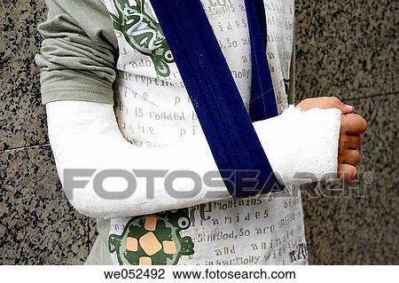 Broken arm View Large Photo Image Stock Image - Broken arm. Fotosearch