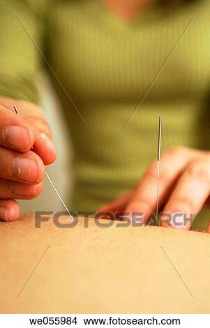 Acupuncture View Large Photo Image Picture - Acupuncture. Fotosearch