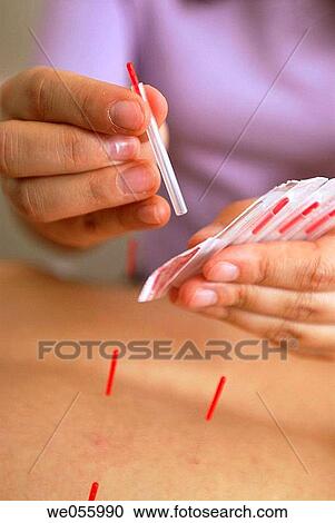 Acupuncture View Large Photo Image Stock Image - Acupuncture. Fotosearch