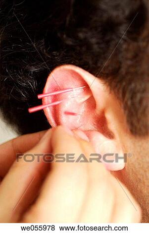 Acupuncture View Large Photo Image Stock Photo - Acupuncture. Fotosearch