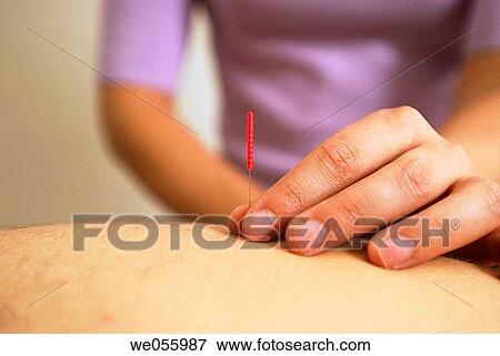 Stock Photo - Acupuncture. Fotosearch
