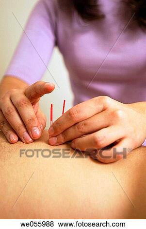 Acupuncture View Large Photo Image Stock Photo - Acupuncture. Fotosearch