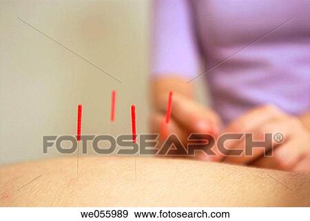 Acupuncture View Large Photo Image Stock Photo - Acupuncture. Fotosearch
