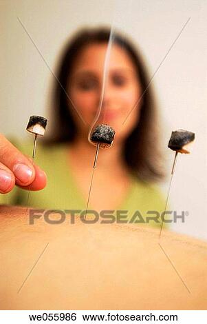 Moxibustion View Large Photo Image Stock Photograph - Moxibustion. Fotosearch