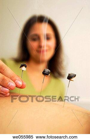 Moxibustion View Large Photo Image Stock Photography - Moxibustion. Fotosearch