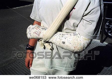 arm, broken, boy, anonymous View Large Photo Image Stock Image - arm, broken, boy, anonymous. Fotosearch