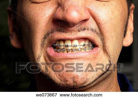 Braces in an angry open mouth View Large Photo Image Stock Photo - Braces in an angry open mouth. Fotosearch