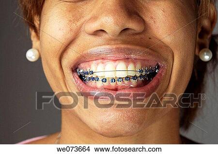 Braces in an open mouth View Large Photo Image Picture - Braces in an open mouth. Fotosearch