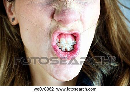 Stock Image - brace, Close-up, detail, Facial expression. Fotosearch