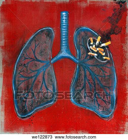 Illustration of lungs and cigarettes View Large Photo Image Stock Image - Illustration of lungs and cigarettes. Fotosearch