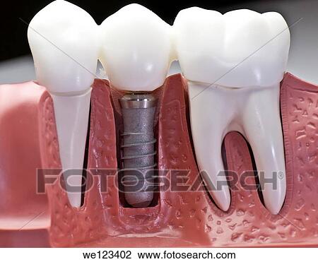 Stock Image - This model show the teeth have been capped and the stainless pin in the gums. Fotosearch