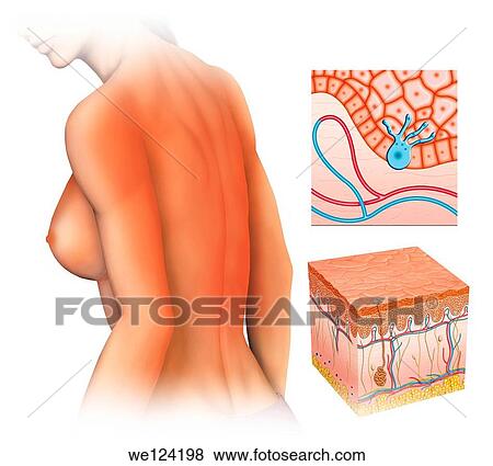 illustration of a woman with burn back a long time caused by sunlight exposure View Large Photo Image Stock Photo - illustration of a woman with burn back a long time caused by sunlight exposure. Fotosearch