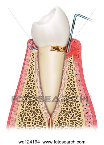 Picture - Illustration of the second phase in which the tooth is affected by gingivitis, gum looseness and swelling and bone deterioration. Fotosearch