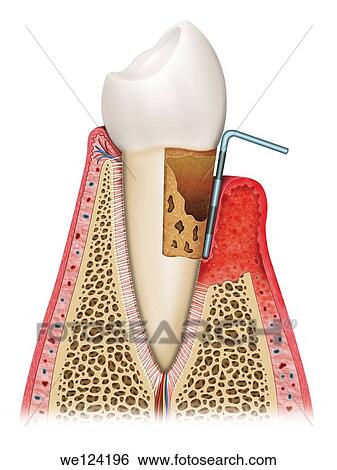 Stock Photograph - Illustration of the tooth terminally affected by gingivitis, degenerative phase with bone and tooth and gum eaten completely reduced. Fotosearch