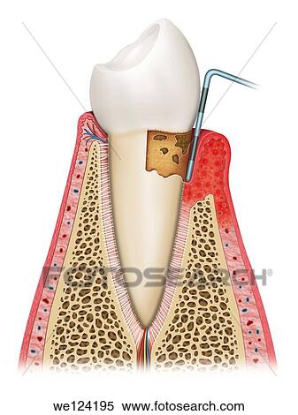 Stock Photography - Illustration of the tooth third phase affected by gingivitis, looseness, swelling, infection of the gum and bone deterioration. Fotosearch