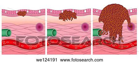 Stock Photography of Illustration of three stages of cancer cells and ...