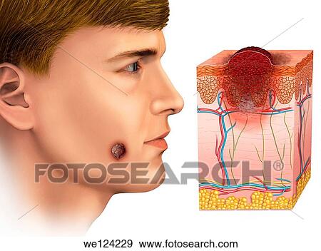Image of a man afflicted with a melanoma on the face View Large Photo Image Stock Photo - Image of a man afflicted with a melanoma on the face. Fotosearch