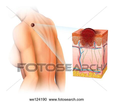 Stock Image - Imagen de una mujer afectada de un melanoma en la espalda y un esquema del desarrollo del melanoma. Fotosearch