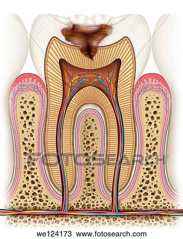 in this image the cari?? has reached an advanced stage, degenerative, reaching dentin drill which involves the deterioration of the tooth and the dentist urgent assistance View Large Photo Image Stock Image - in this image the cari?? has reached an advanced stage, degenerative, reaching dentin drill which involves the deterioration of the tooth and the dentist urgent assistance. Fotosearch