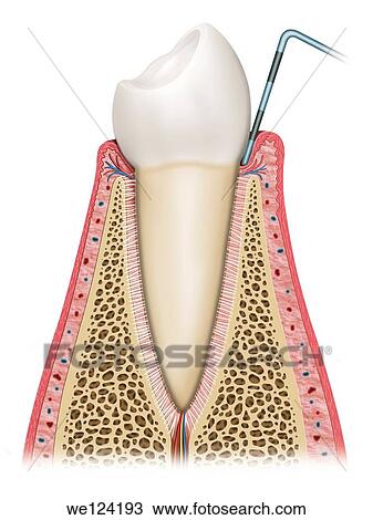 Stock Image - Schematic illustration in which the tooth is affected by gingivitis, gum and swelling ease. Fotosearch