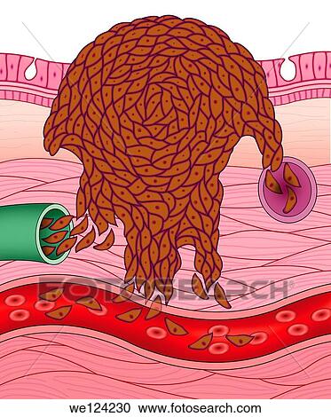 Stock Image - schematic illustration of the expansion of the cells until a cancerous metástasis. Fotosearch