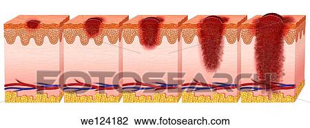 schematic illustration of the process and development of melanoma metastases until View Large Photo Image Stock Image - schematic illustration of the process and development of melanoma metastases until. Fotosearch
