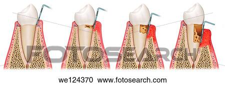 Stock Image - Schematic illustration where you can see the different stages of this infection.. Fotosearch