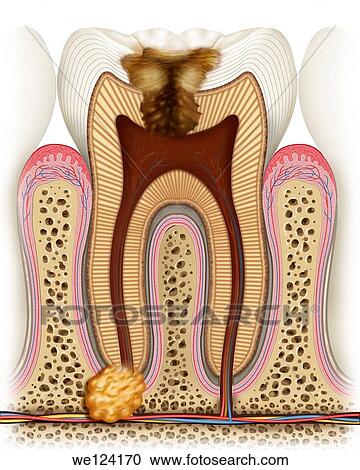 Stock Image - This illustration shows us how the caries has reached its maximum degeneration destroying the wheel with arteries, veins and nerves completely useless and producing a visible infection in the root of the tooth called dental abscess. Fotosearch
