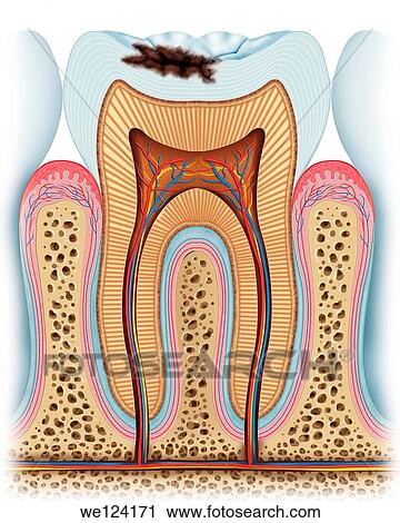 Stock Image - This image teaches us an advanced stage cari? which already has delved into the crown of the tooth, it will continue growing as the days go if the patient does not visit your dentist urgently. Fotosearch