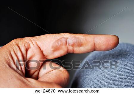 Stock Image - A burn blister on an index finger, Poona, Maharashtra, India.. Fotosearch