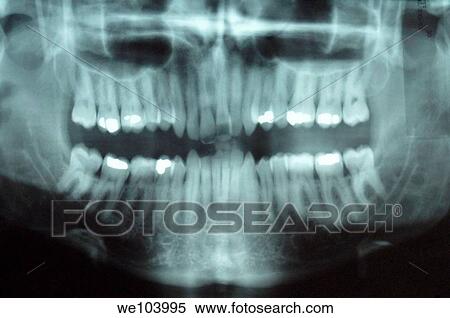 Dental X-rays View Large Photo Image Stock Photography - Dental X-rays. Fotosearch